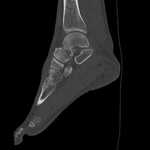 this picture shows the broken Talus in the middle of the foot.